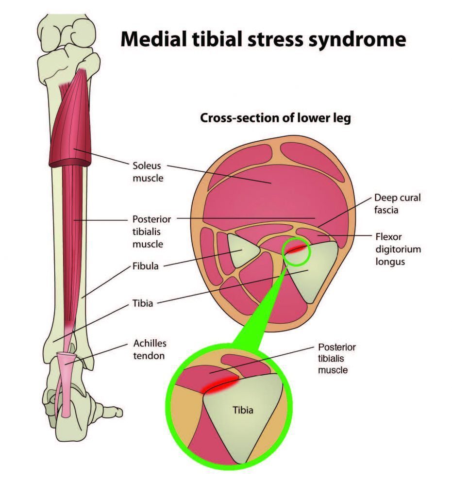 Symptoms Of Sciatica In Athletes Due To Shin Splints El Paso Back 