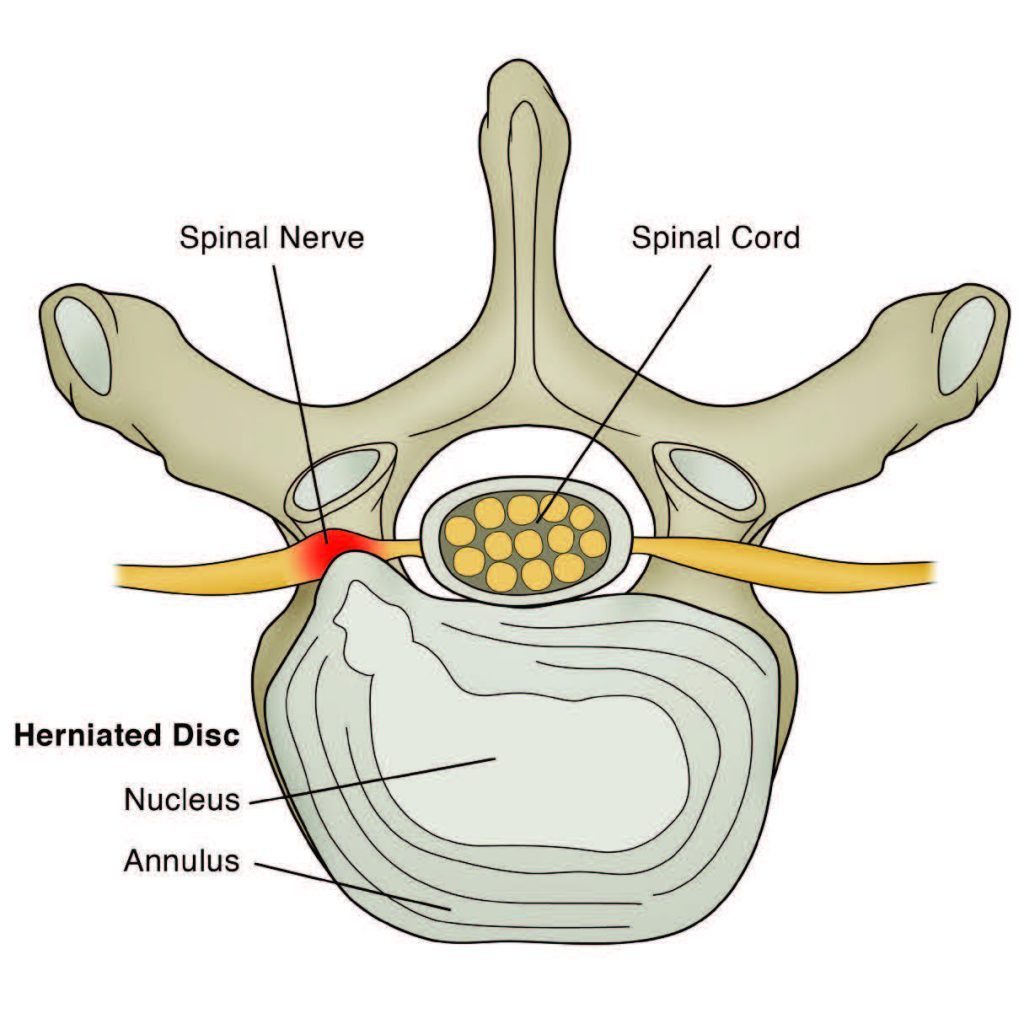 Lumbar Disc Herniation, Massage and Chiropractic - El Paso, TX Doctor ...