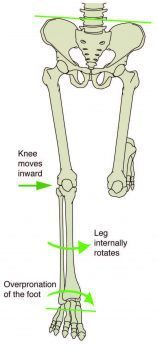 Symptoms of Sciatica in Athletes Due to Shin Splints - El Paso, TX ...