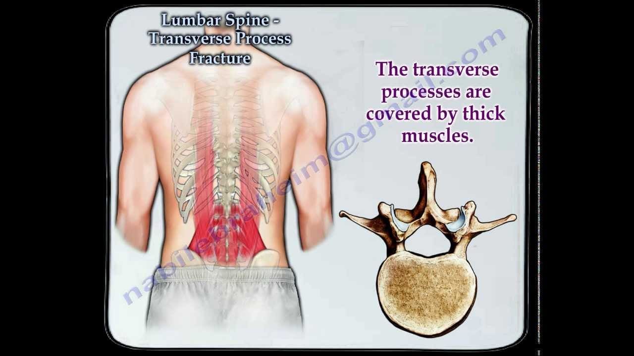 icd 10 imuscle sprain mid thoracic