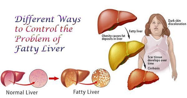 el blog ilustración de un hígado graso