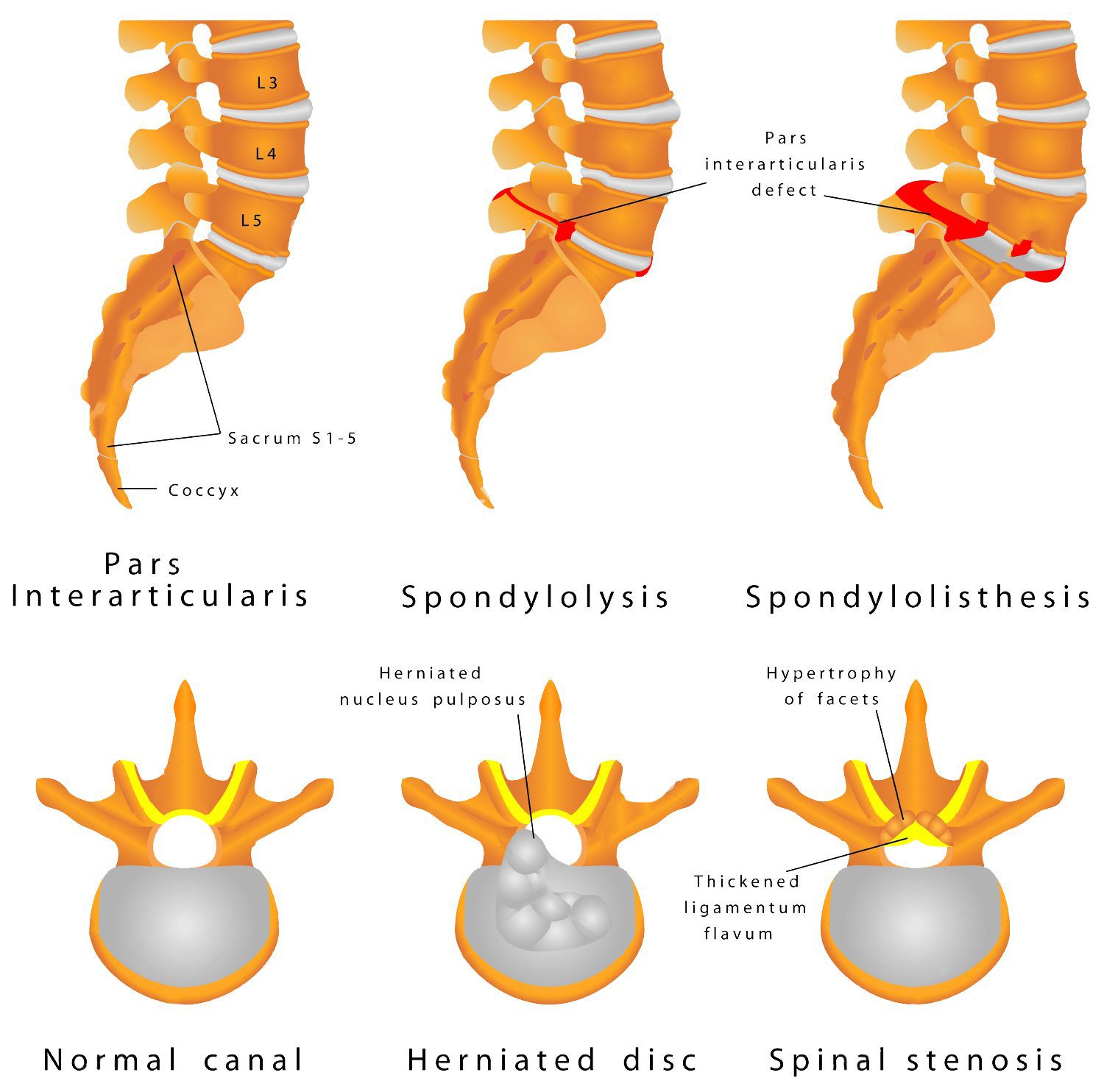 what-are-spondylolysis-and-spondylolisthesis-rural-physio-at-your-my