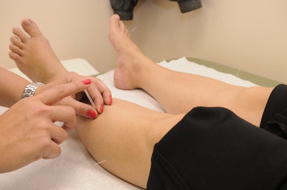 Acupuncture Therapy for Arthritis Relief: A Guide
