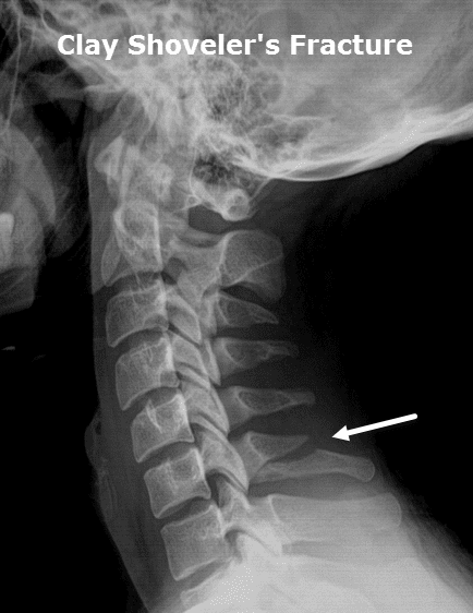 broken vertebrae x ray