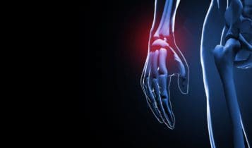 Scaphoid Fracture: How It Occurs and Heals