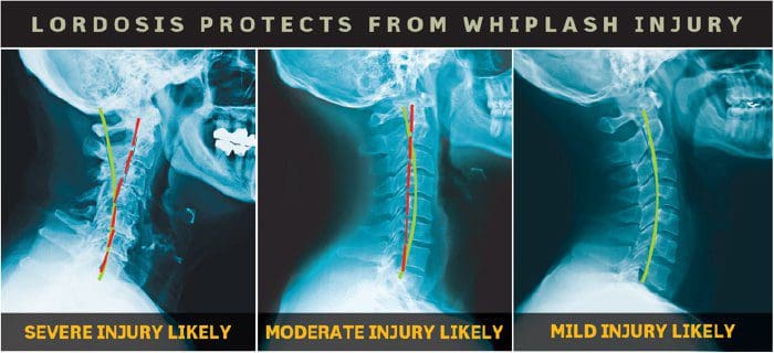lordosis protects from whiplash - El Paso Chiropractor