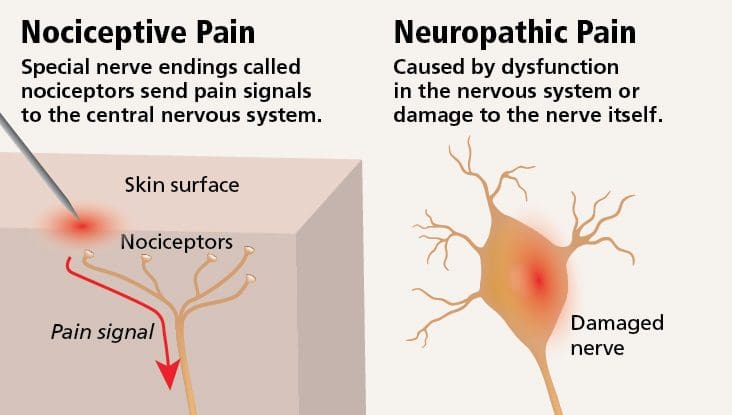 Neuropathic-Pain-vs-Nociceptive-Pain-Diagram-1.jpg