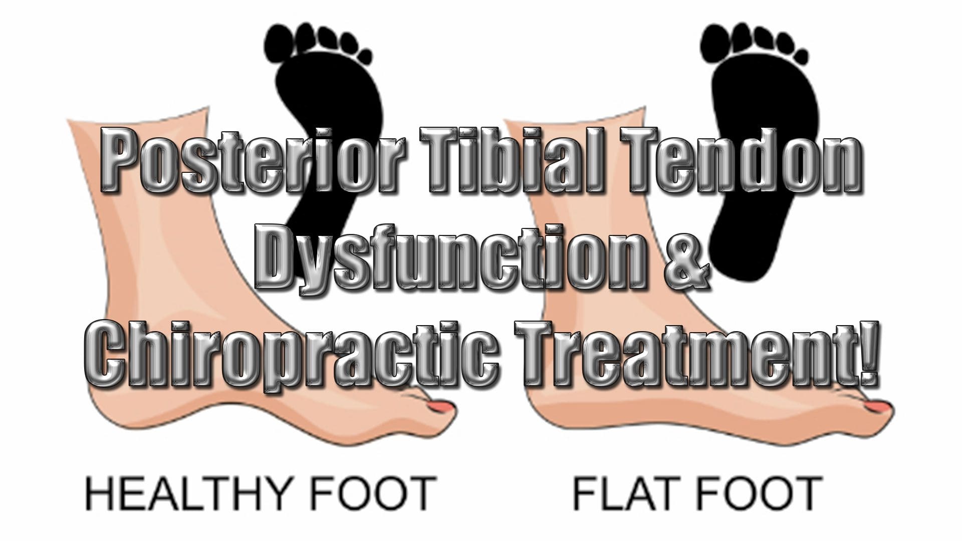posterior tibial tendon dysfunction el paso tx.