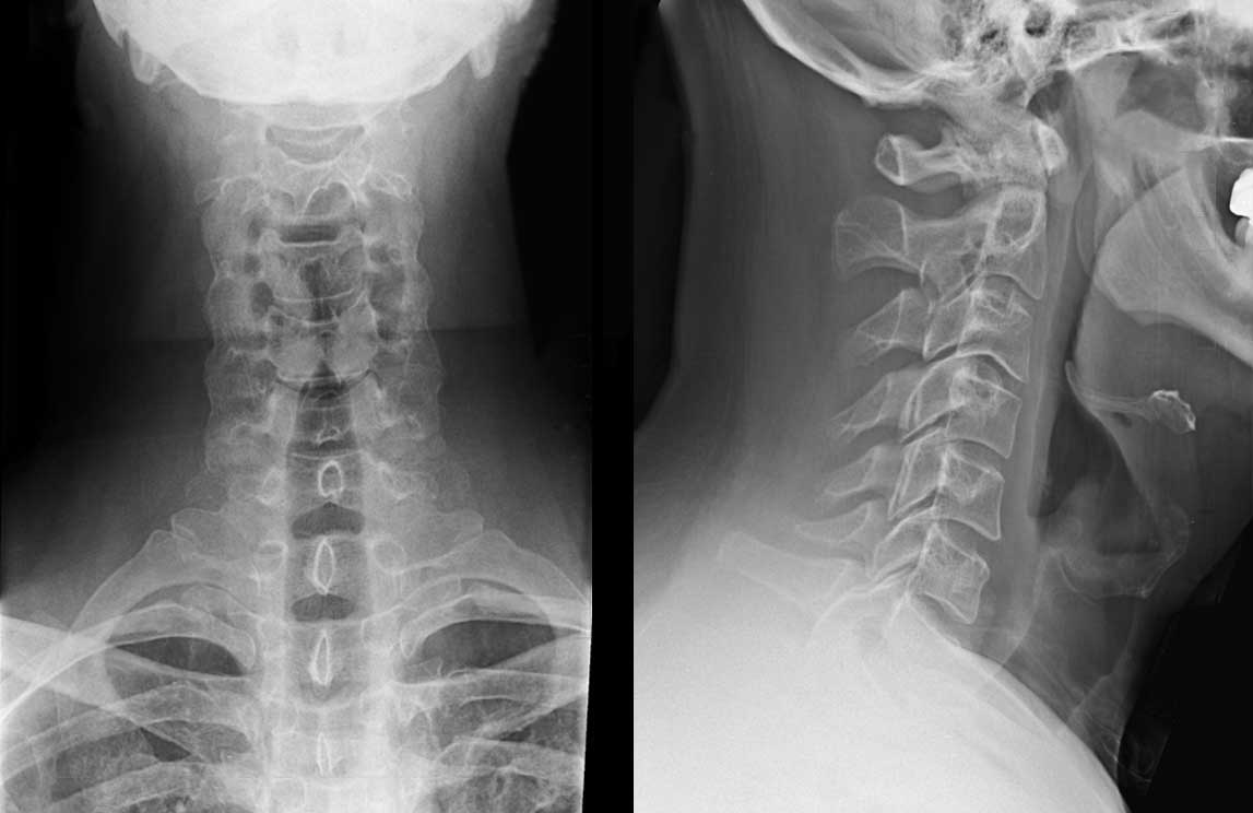 Radiografías de la columna cervical en el paciente con trauma | El Quiropráctico El Paso, TX
