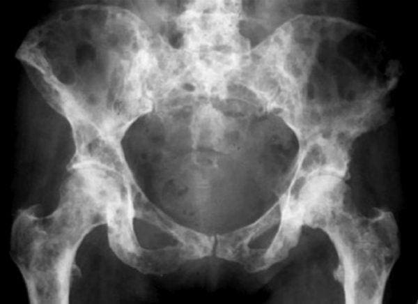 ¿Qué es la enfermedad ósea metastásica? | El Paso, TX Quiropráctico