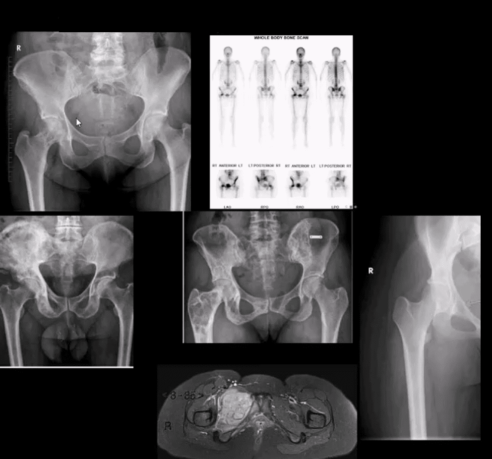diagnosis hip arthritis and neoplasms el paso, tx.