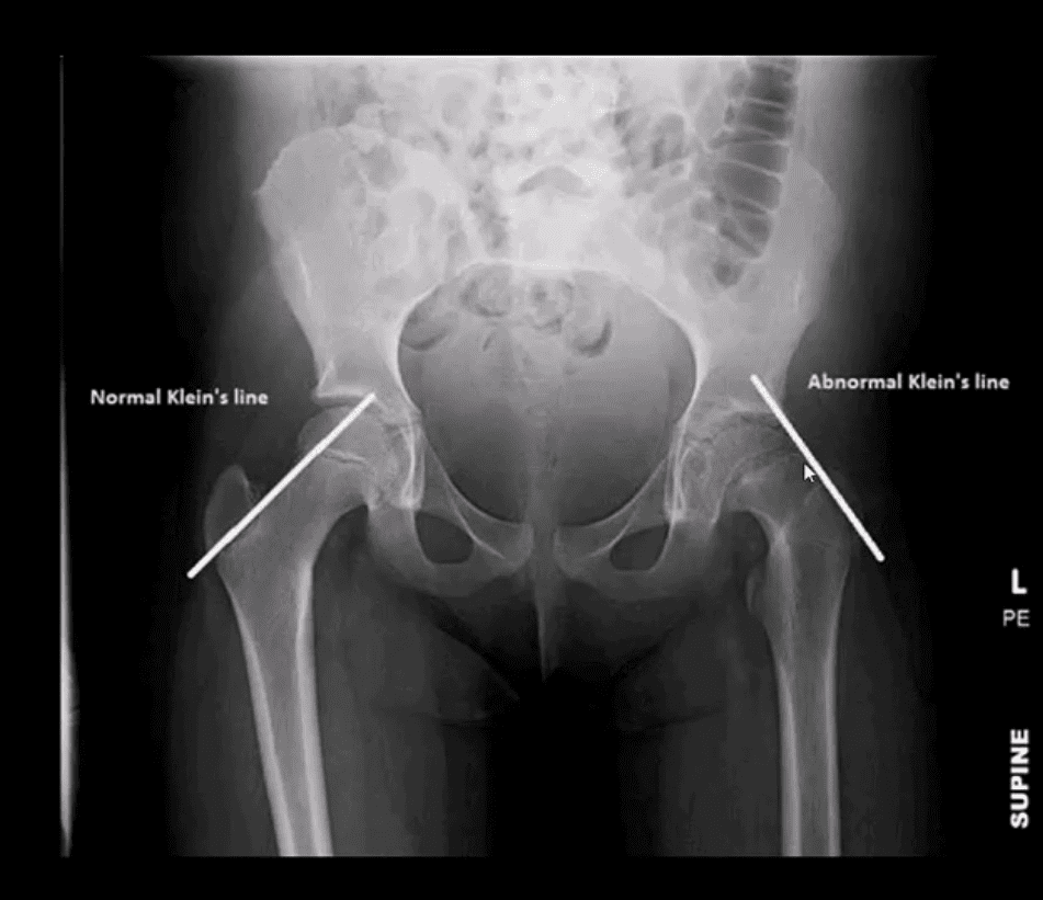 diagnosis hip arthritis and neoplasms el paso, tx.