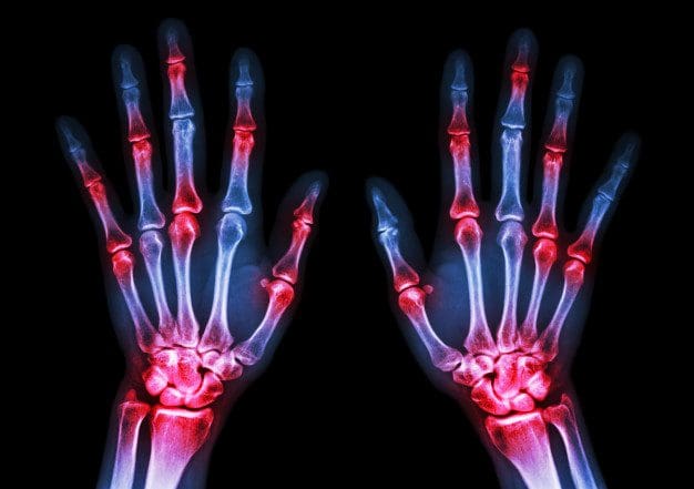 X-ray image of hands demonstrating rheumatoid arthritis.