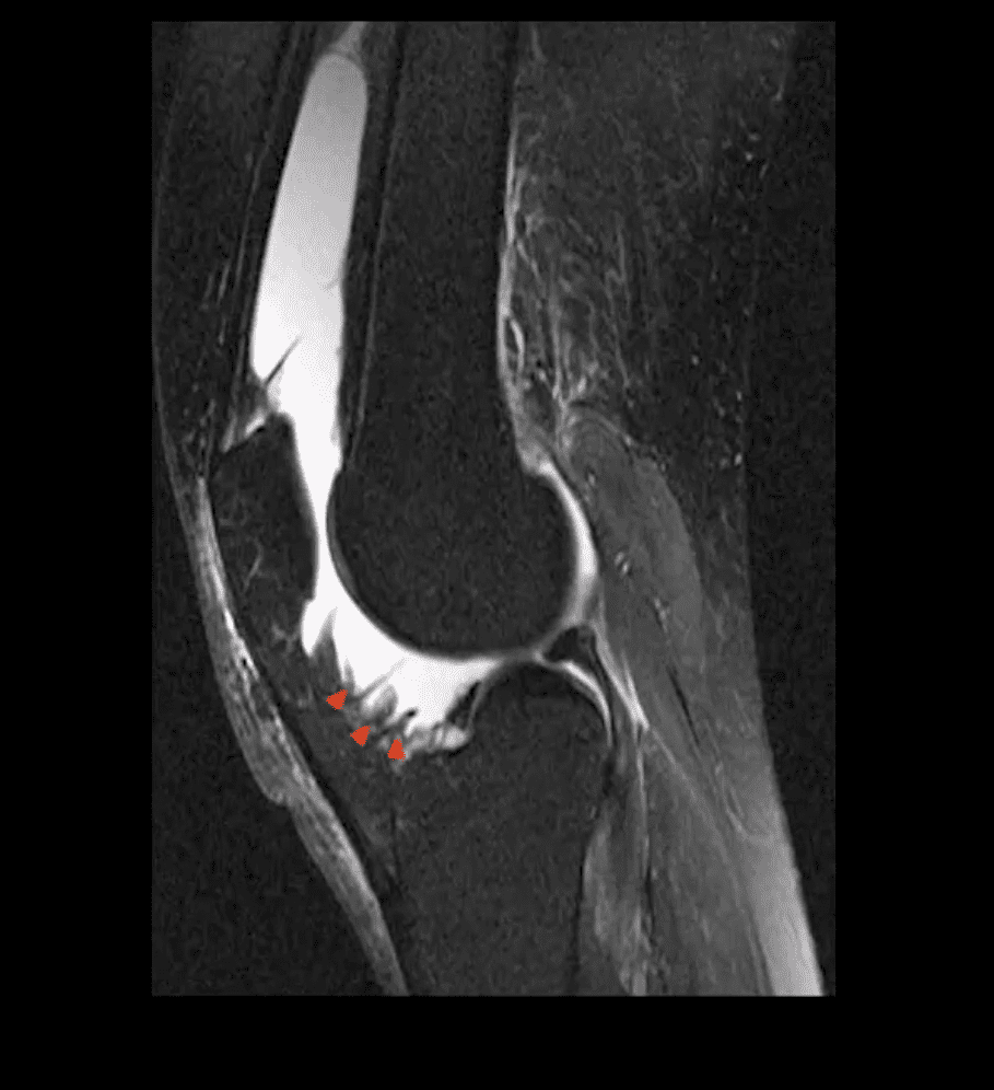 Artritis de rodilla atención quiropráctica el paso tx.