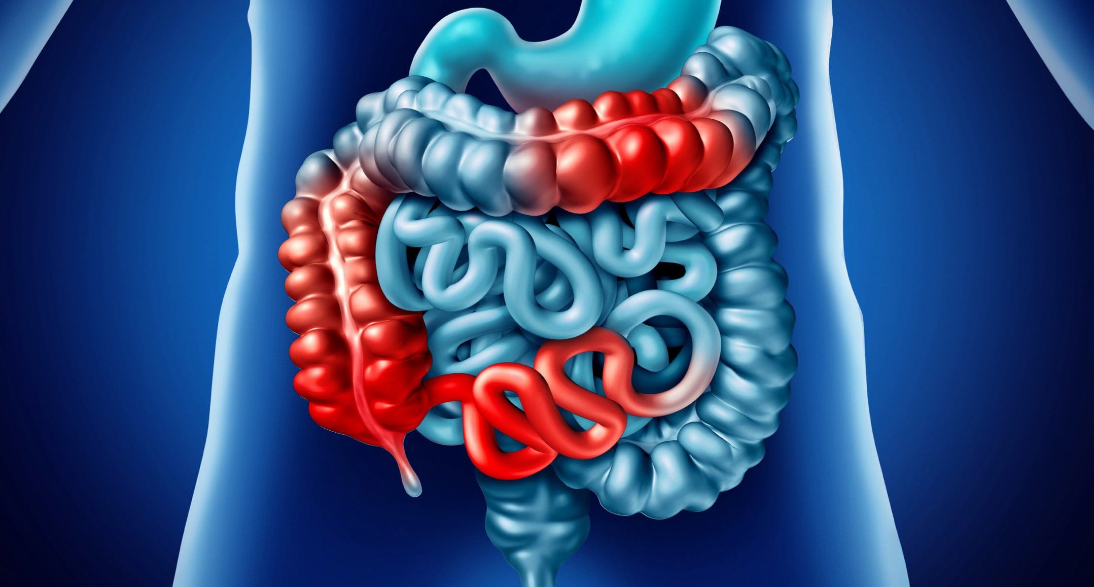 ¿Qué es la enfermedad de Crohn? Una descripción general | El Paso, TX Quiropráctico