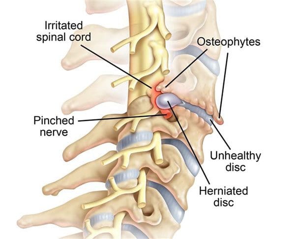 Intervertebral Foramen: The Gateway to Spine Health