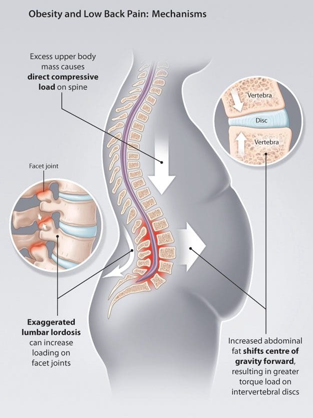 Obesity Pressure and Herniated Discs