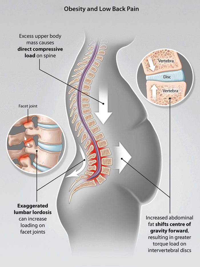 11860 Vista Del Sol, Ste. 128 Belly Fat Can Cause Back Pain and Injury