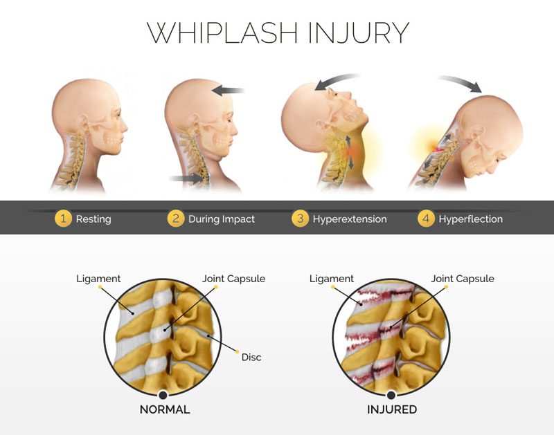 How soon after whiplash can I go to chiropractor?