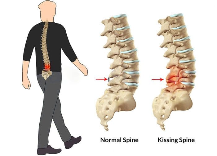 11860 Vista Del Sol, Ste. 128 Baastrup's Syndrome aka Kissing Spine Syndrome