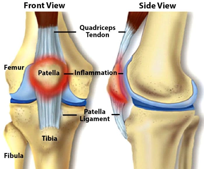 Lesioni al ginocchio, interventi chirurgici e stato di vitamina D