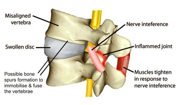 Sintomi di disallineamento spinale e chiropratica