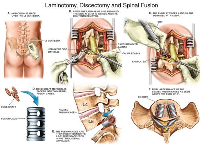 discectomy and laminectomy