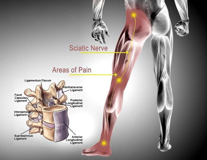 Le sciatic nerve