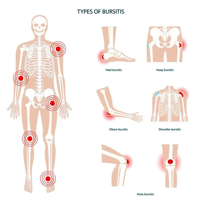 Tipos de bursitis