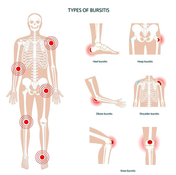 Bursitis Types Ep Wellness Functional Medicine Clinic