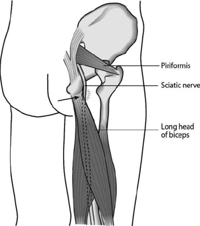 Sindrome del bicipite femorale, sciatica e chiropratica