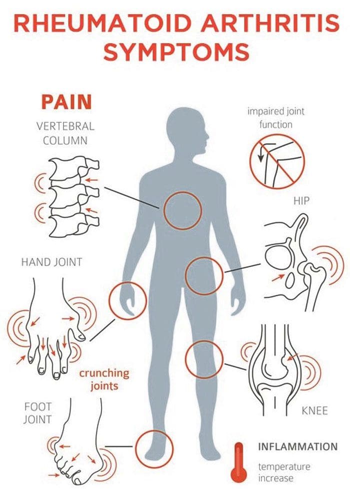 Rheumatoid Arthritis Flare-Ups Pulega