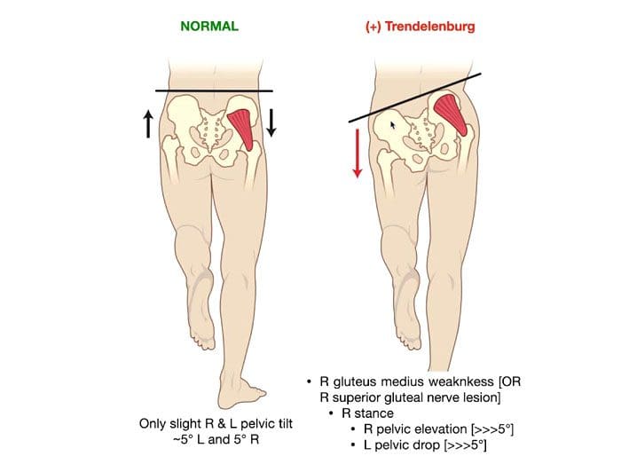 Andatura Trendelenburg