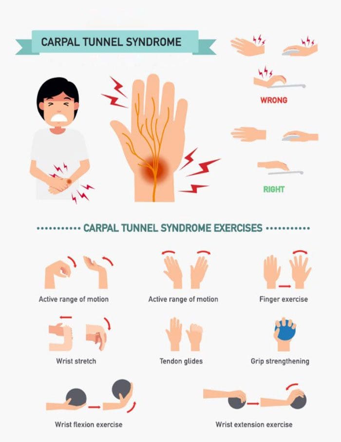 Prevención do túnel carpiano