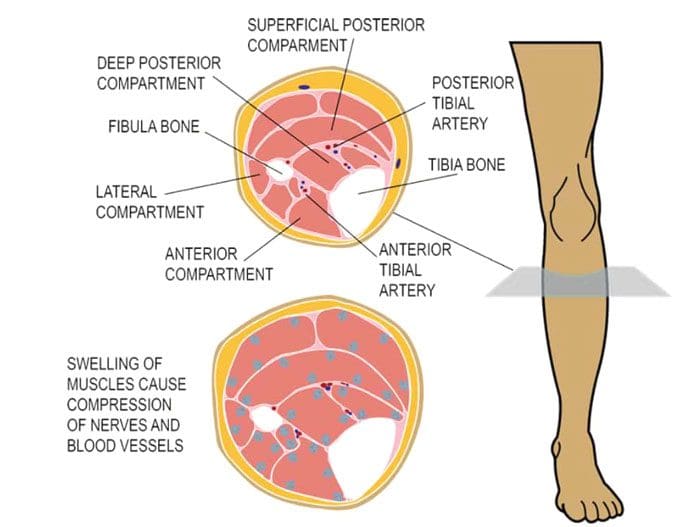 Sindrome compartimentale Dolore alle gambe