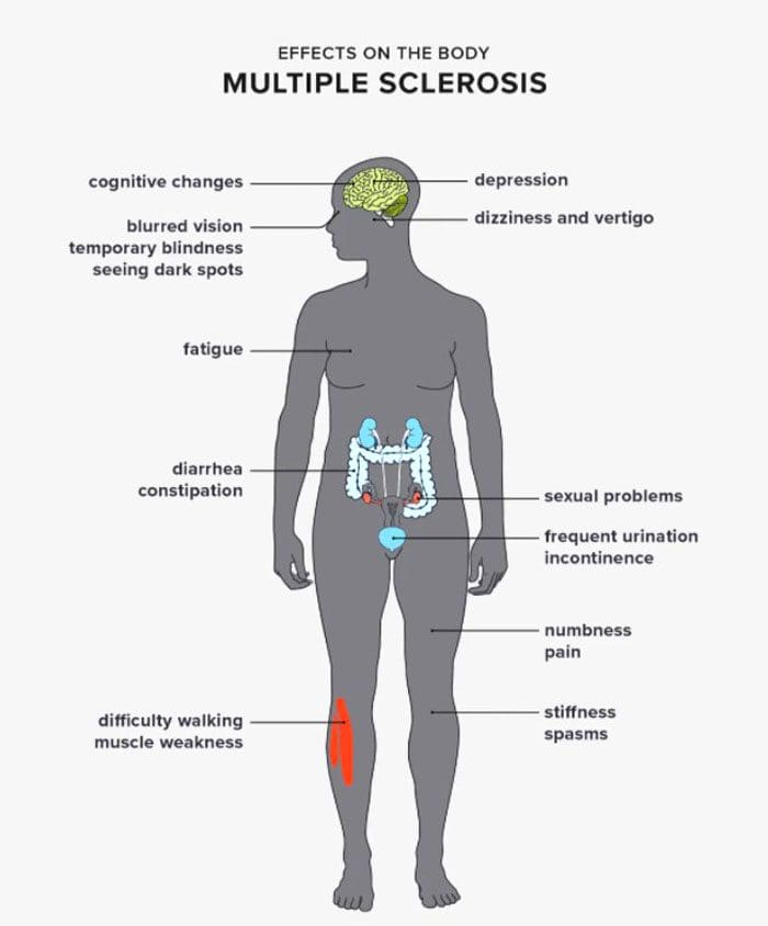 sciatic nerve pain