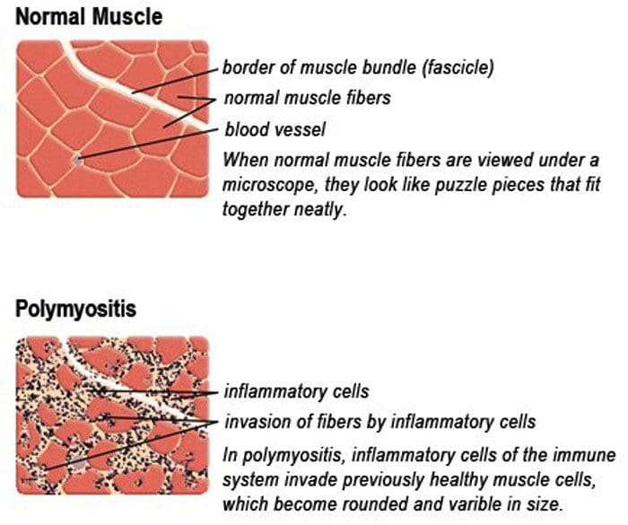 Polimiositis: miopatía inflamatoria