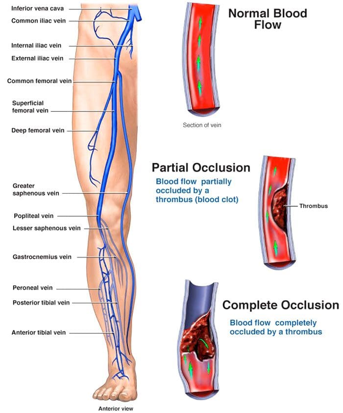 Leg Pain When Running Long Distance