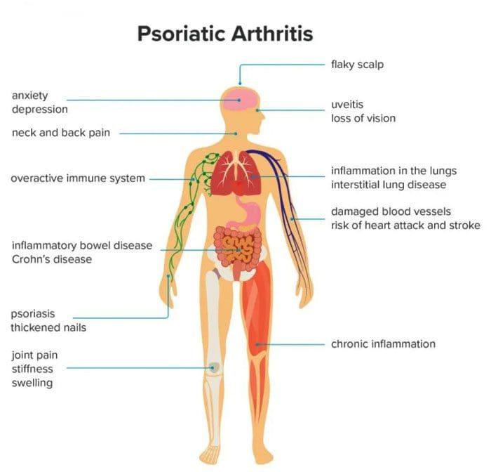 Psoriatic Arthritis දණහිස් වේදනාව