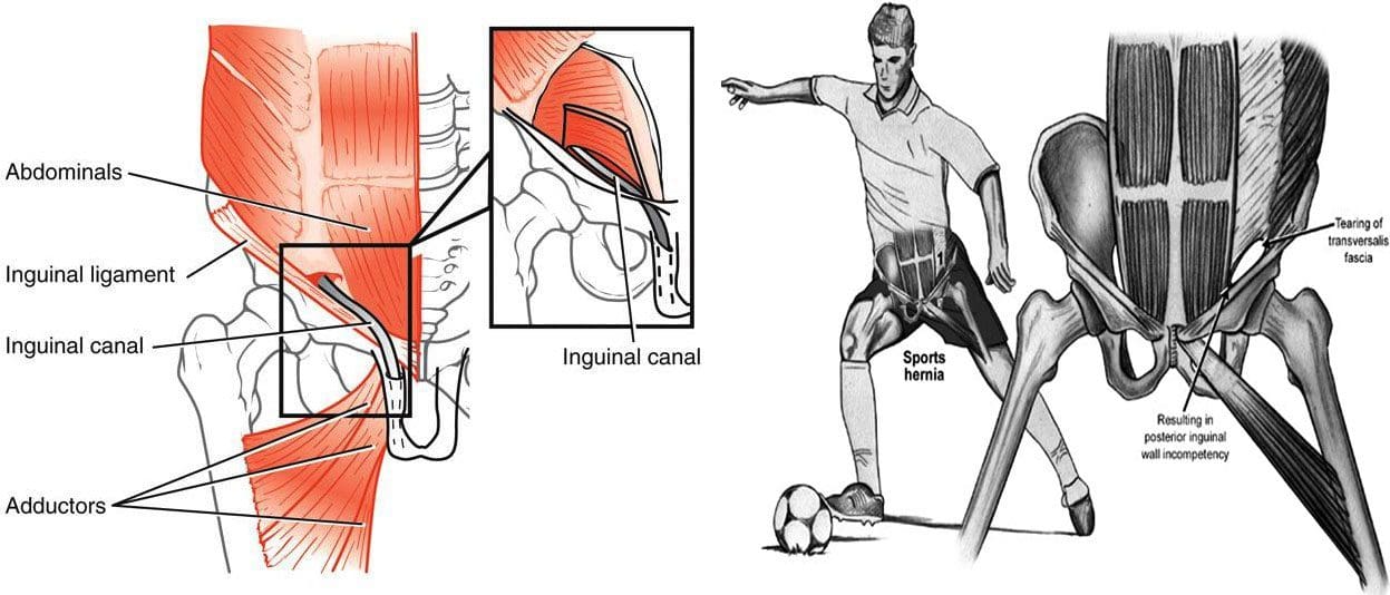 Idaraya Hernia: Ipalara Isan mojuto