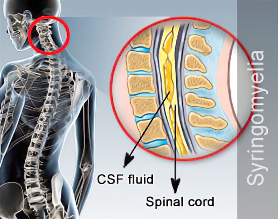 syringomyelia spinal cord