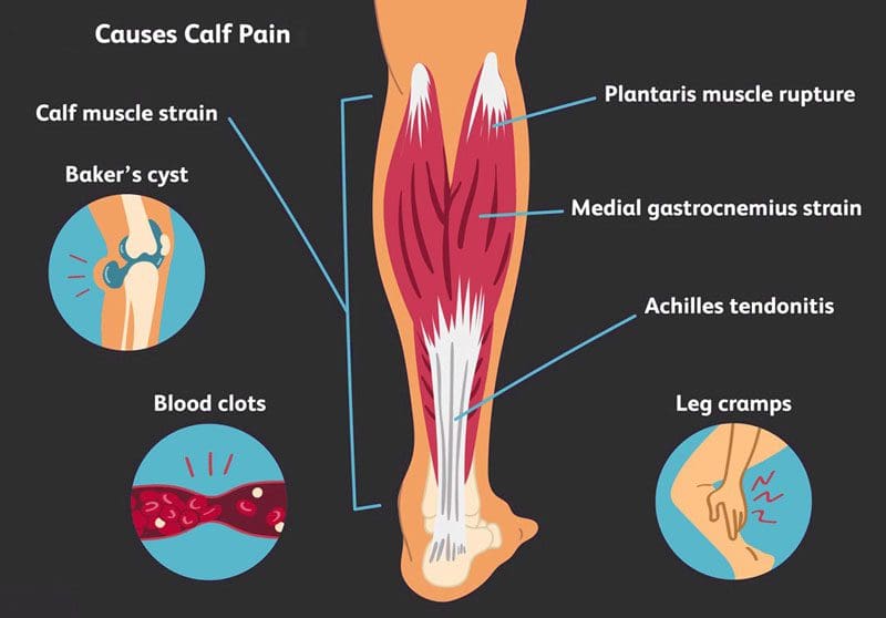 Tensione muscolare del polpaccio e lesioni