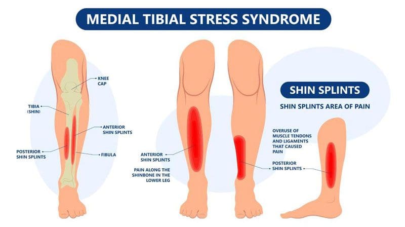 Mediaal tibiaal stresssyndroom: scheenbeenspalken