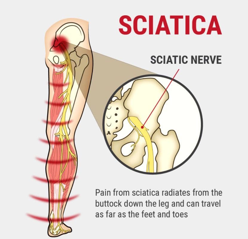 sciatic nerve pain