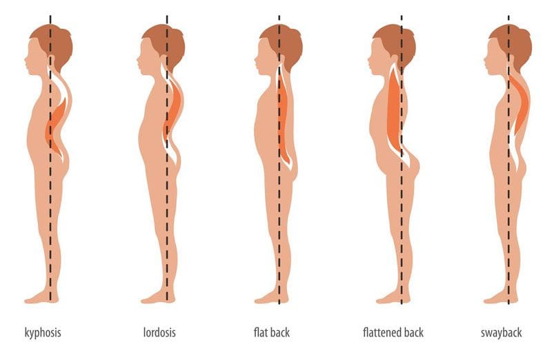 Síndrome de espalda plana - El Paso, TX  Clínica de tratamiento y dolor de  ciática