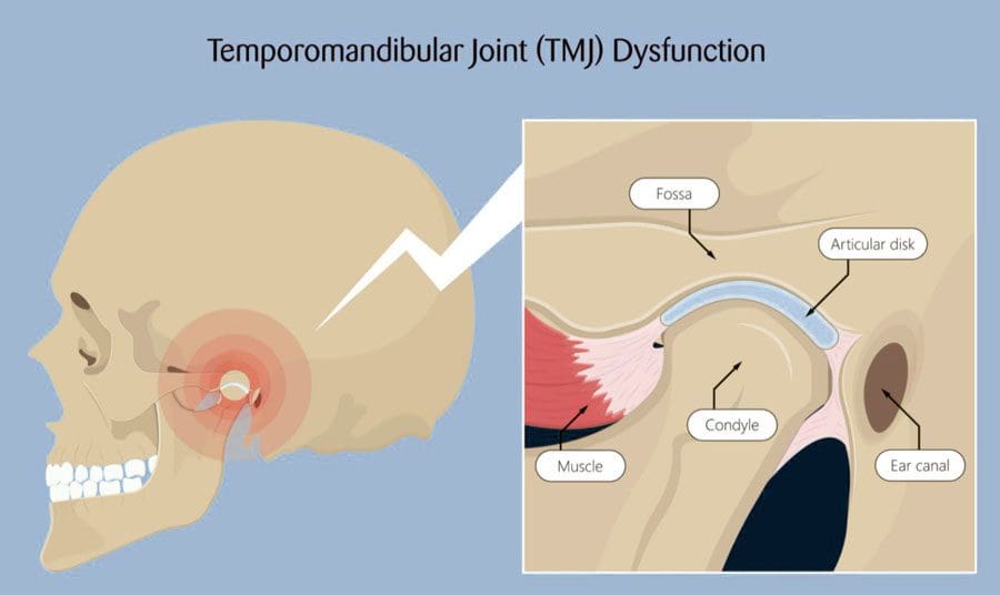 TMJ: જડબાની વિકૃતિઓ