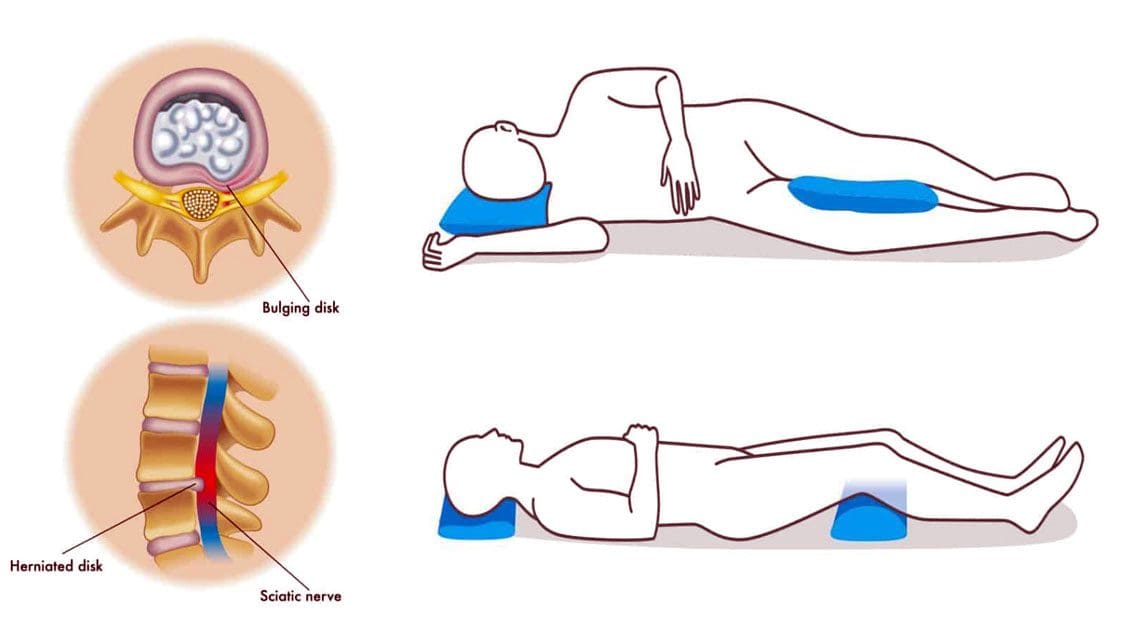 Sleeping With A Bulging Disc