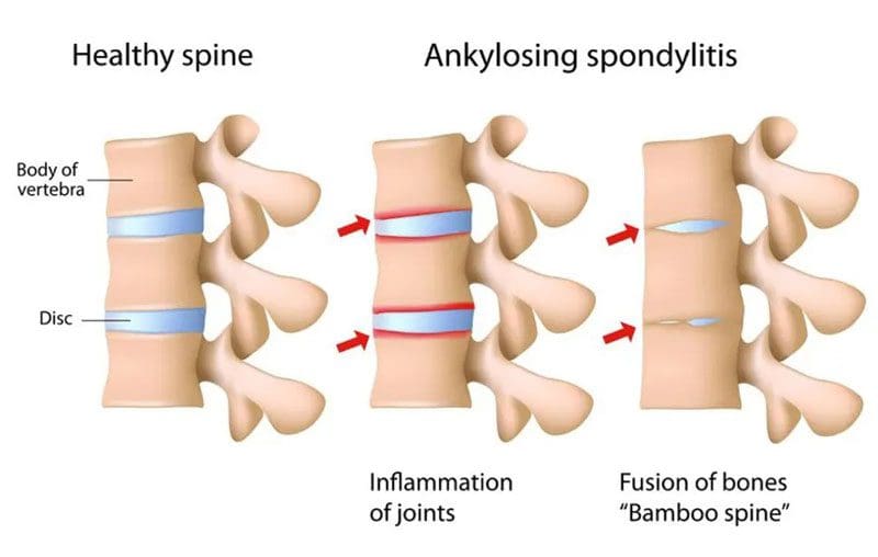 Spondylitis Anti-Inflammation Diet