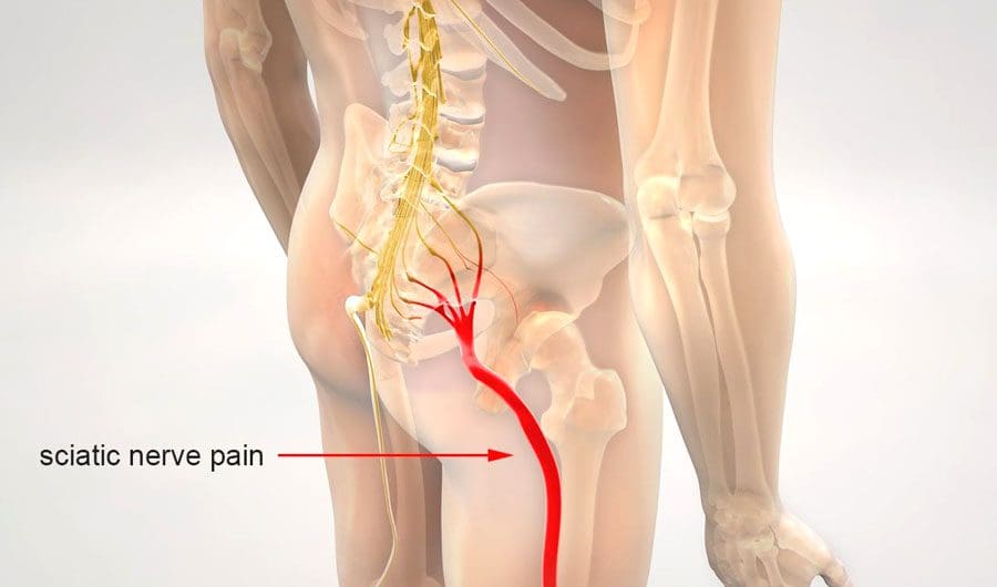 Sciatica: MedlinePlus Medical Encyclopedia