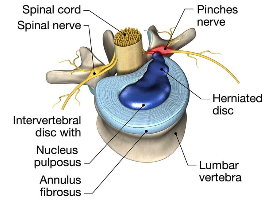 Spinal Decompression Institute